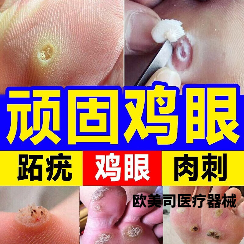 鸡眼贴脚趾鸡眼膏跖疣去除足部根跖疣鸡眼手部穴位贴疣瘊去