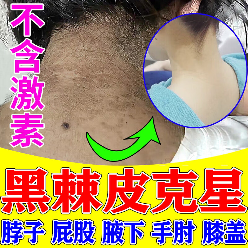 黑棘皮病治脖子黑色素去除脖子黑洗不干净膏全身颈部腋下淡化色素 1盒