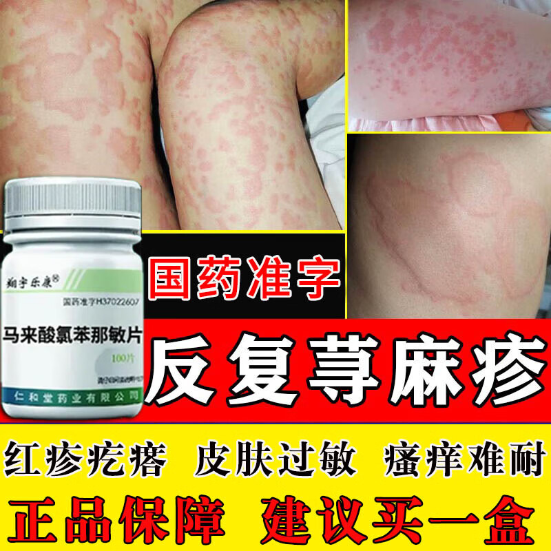 过敏止痒根儿童反复荨麻疹傚药身上痒起红疙瘩断药根马来酸氯苯那敏片