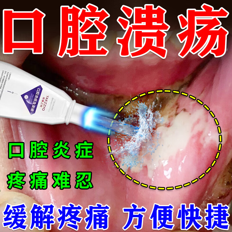 口腔溃疡漱口水儿童反复性溃烂气泡嘴巴上火舌头起泡专用非喷雾药特傚