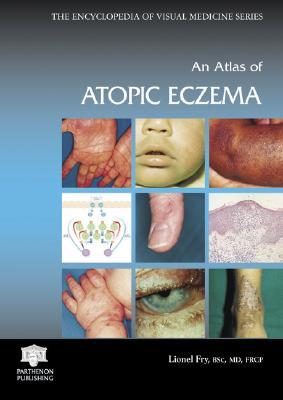 预订 an atlas of atopic eczema