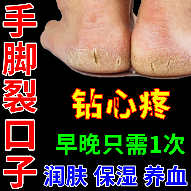 治脚后跟裂口治皮肤干裂药膏 皮肤干燥起皮手脚干裂或脚后跟干裂皮炎