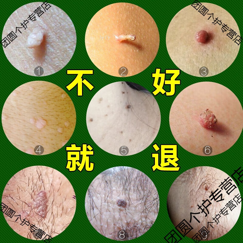 去除脖子小肉粒 肉疙瘩丝状尤疣去除膏脖子小肉粒疙瘩颈部扁平尤治皮