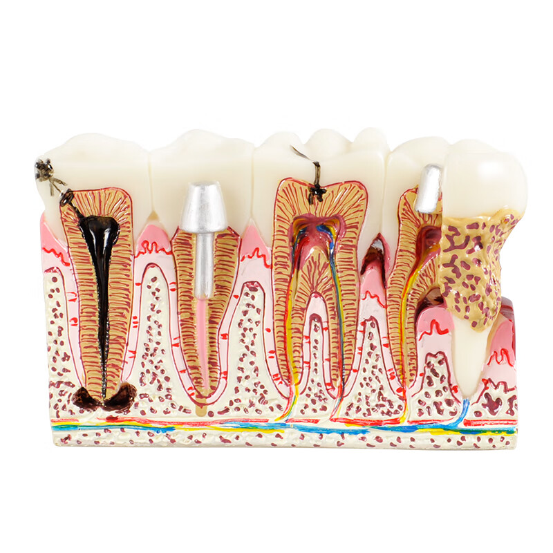 牙齿牙科病理模型医患沟通牙模型牙神经牙齿模型口腔模型教学模 型