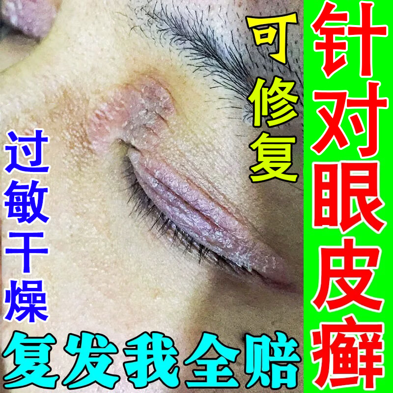 眼皮癣眼皮红肿痒过敏干燥消肿眼睛周围过敏眼角瘙痒脸起皮有碎屑神经