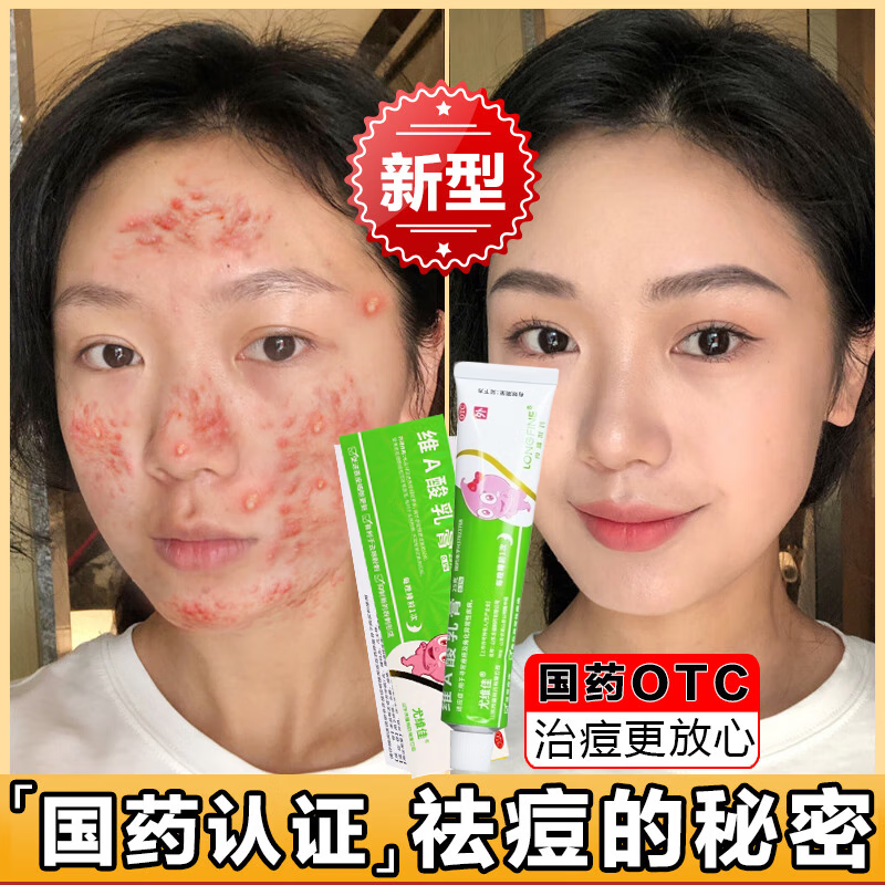 印修复淡化痘印痘坑修复药膏去痘痘和痘印女孩学生医用的药维a酸乳膏
