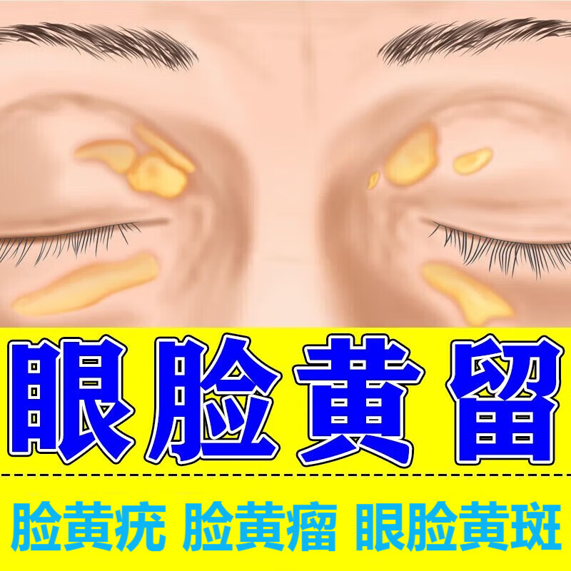 消瘤散结保健膏 眼睑黄瘤睑黄疣脸黄瘤眼部眼睑黄瘤脂肪粒汗管瘤眼皮
