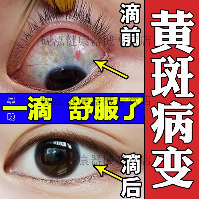 眼部黄斑 视物模糊 疲劳 视力下降畏干涩色觉异常 眼底有黄斑盒轻度装