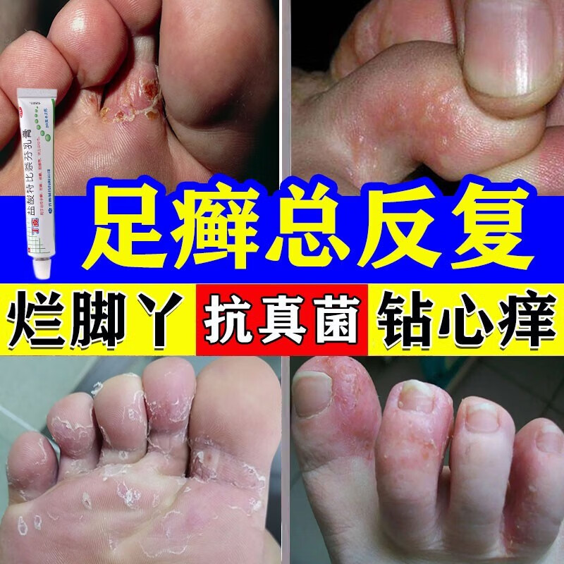 香港脚会传染吗图片