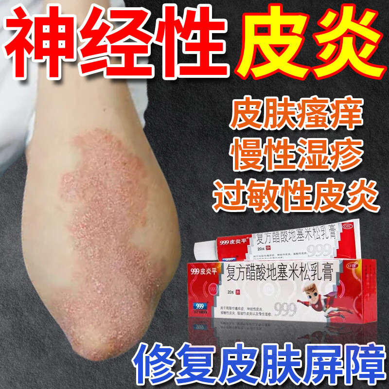 神经性皮炎专用药皮肤瘙痒皮炎顽固湿疹真菌感染止痒特效药膏抑菌癣