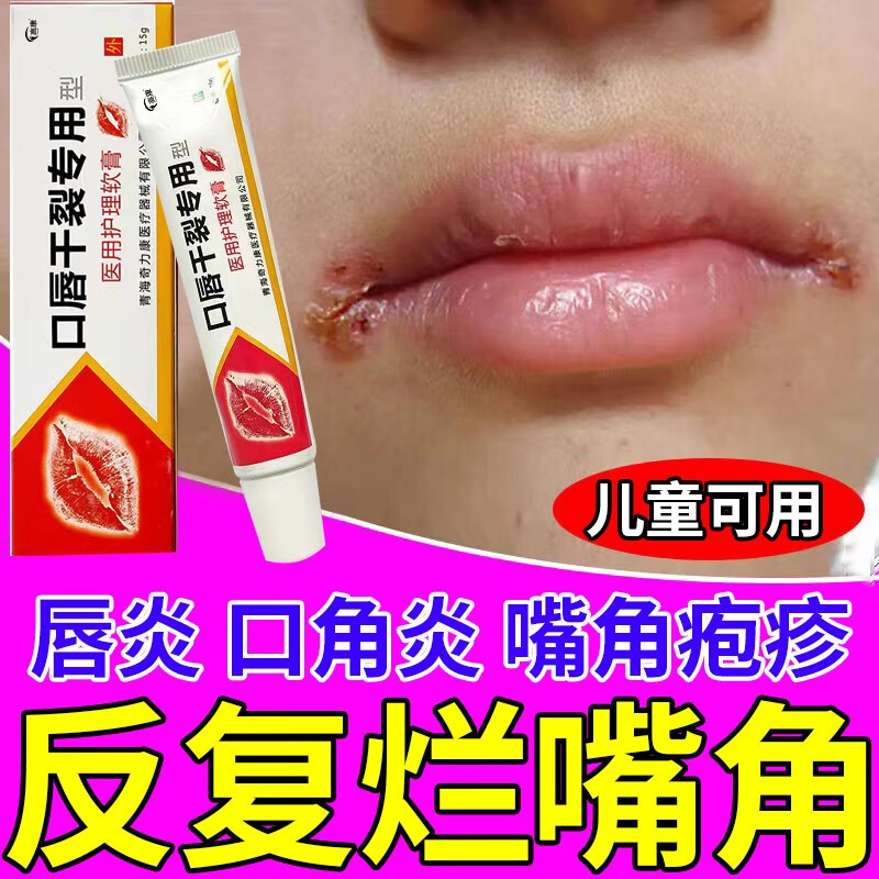 口周皮炎儿童烂嘴角唇炎专唇膏口角炎嘴角干裂起皮用嘴唇起泡唇炎 单