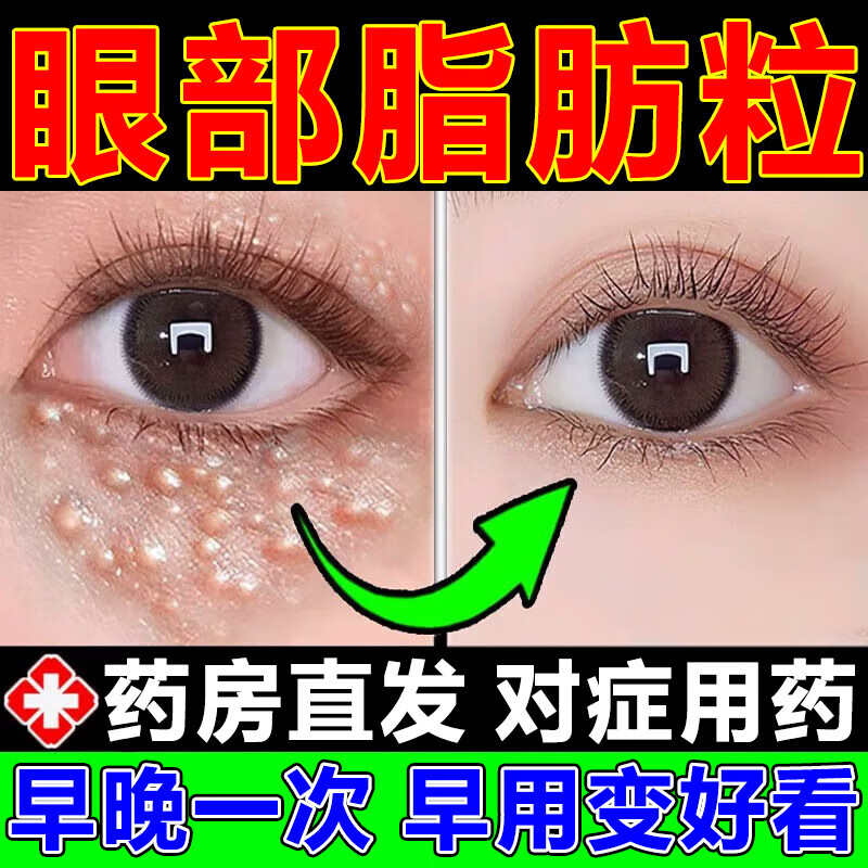 脂肪粒药膏汗管去除针神器眼霜眼部专用膏药白色颗粒去油脂粒瘤精华液