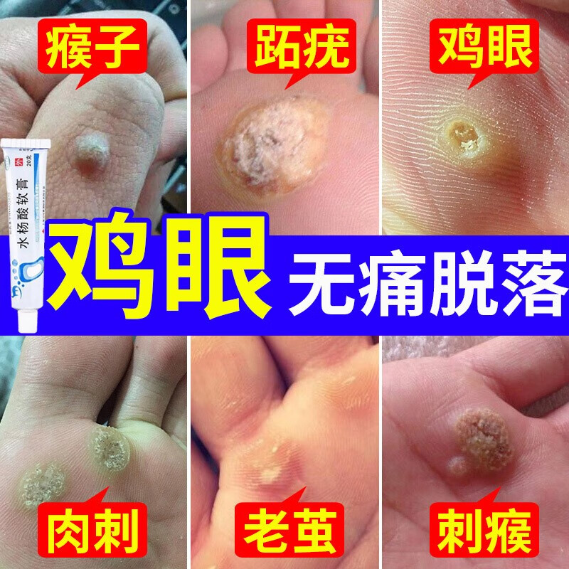 水杨酸软膏 鸡眼膏 去药肉刺药膏成人脚底脚趾鸡眼跖疣瘊子老茧角质