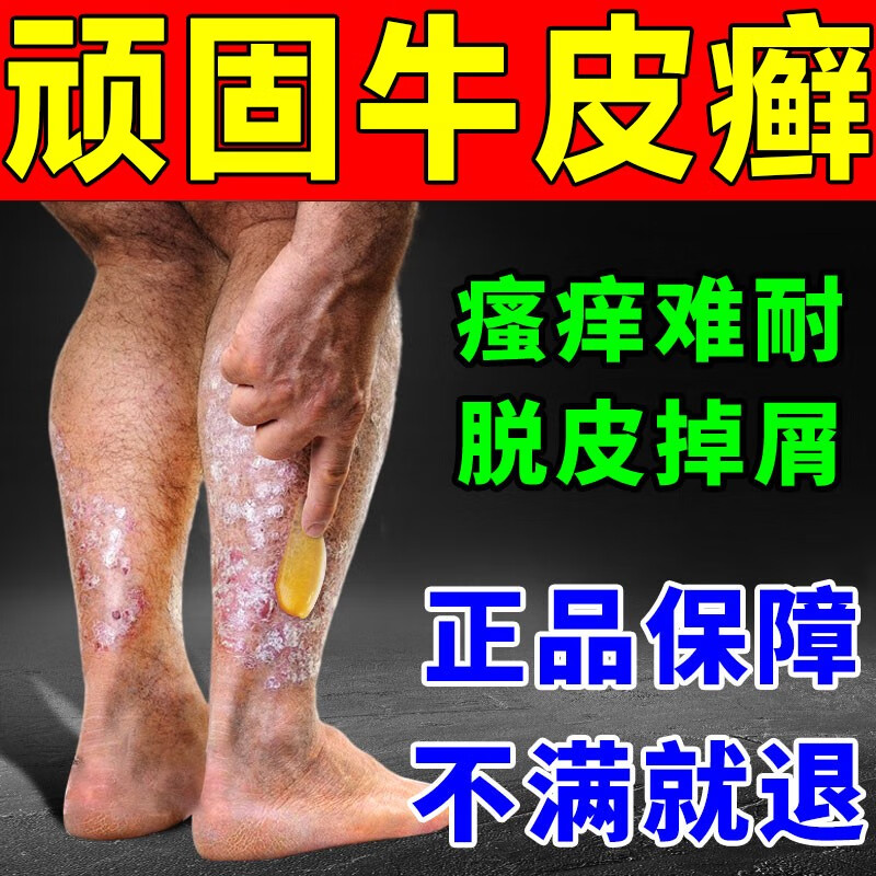 牛皮癣专用顽固药银屑膏病头癣手足癣皮炎慢性湿l疹苗药皮肤瘙痒 一