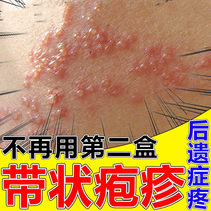 蛇盘疮断跟克星后遗症外用药带状疱l疹蛇胆疮蛇缠腰病毒止l痛膏 买2 1