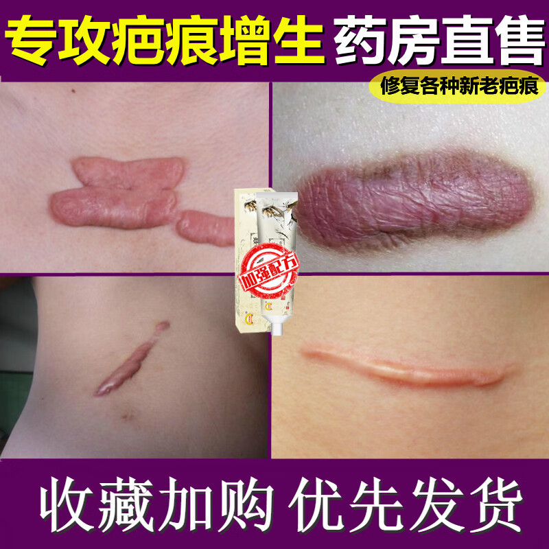 疤痕增生凸起去除疙瘩疤痕灵修复膏增生凸起手术旧伤疤贴沉淀疙瘩