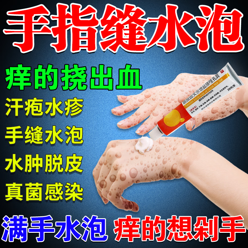 手上长小疙瘩手指长水泡发痒真菌感染杀菌止痒醋酸曲安奈德益康唑乳膏