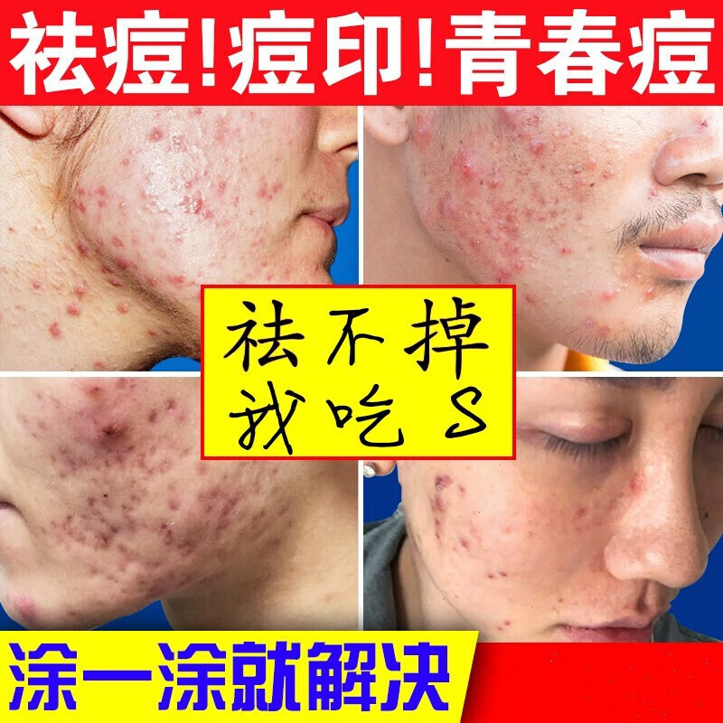 修正草本祛痘膏青少年初高中生青春期青春痘上火熬夜痤疮粉刺面霜 1瓶