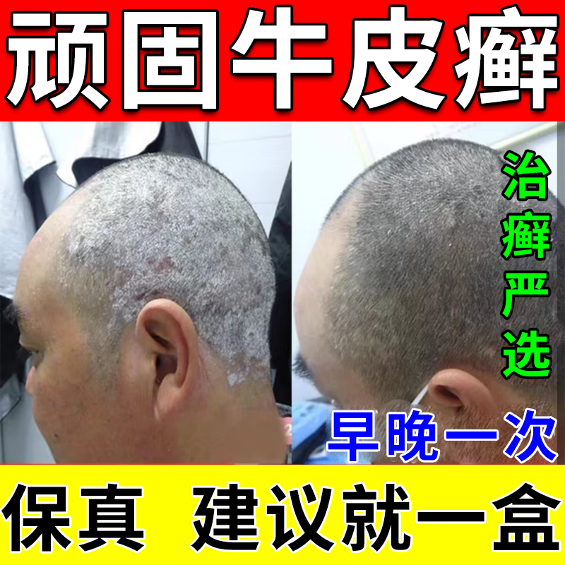 牛皮癣药银屑病治疗中药难根 疗癣卡西甫散 治疗牛皮癣成人 顽固