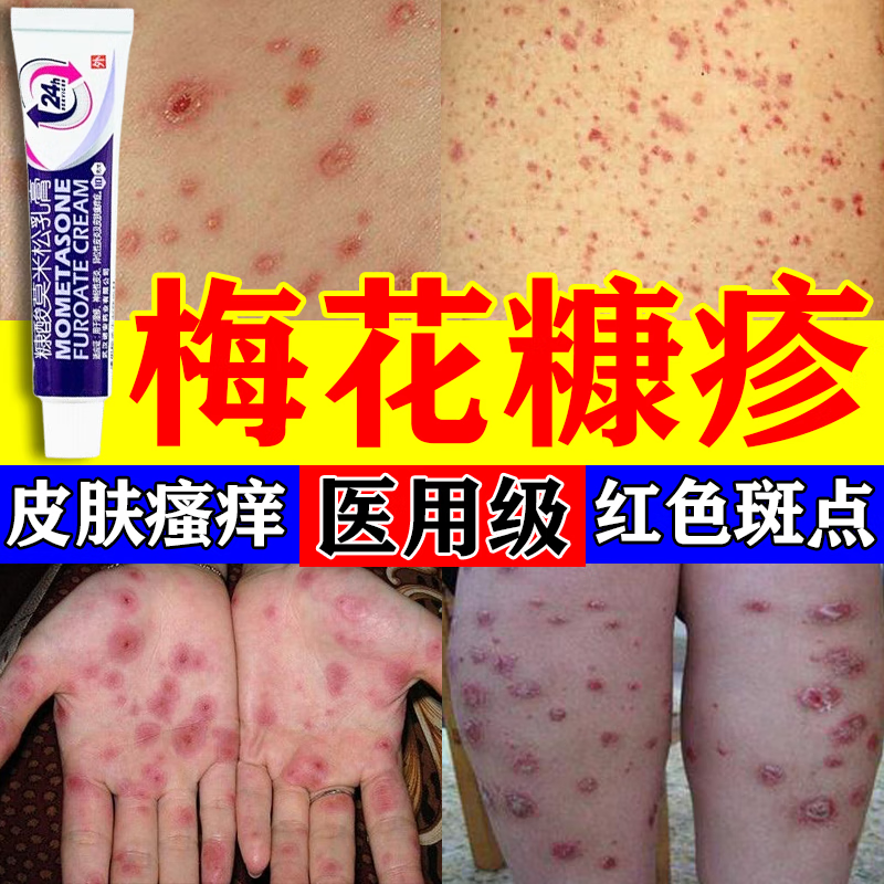 梅花糠疹专用药膏】治皮肤瘙痒皮炎湿疹背部胸部红斑铜钱癣玫瑰糠疹