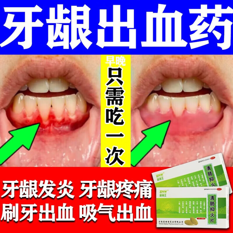 溃疡牙疼吃什么药治牙疼痛的药牙龈肿痛清肺抑火片牙龈出血口腔用药