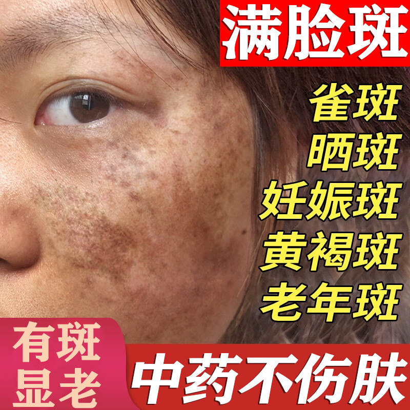 黄褐斑内调去除黄褐斑口服药淡化黑色素肝斑淡斑治满脸色斑老年斑一夜