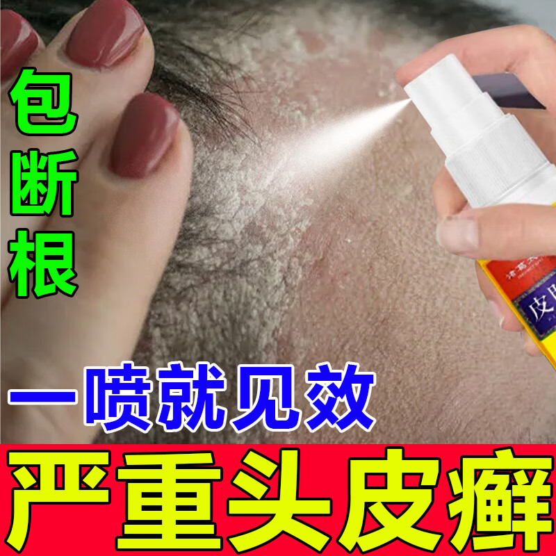 诸葛太医头皮癣专用头屑头皮癣头痒真菌感染头皮屑多治疗专用去屑头癣