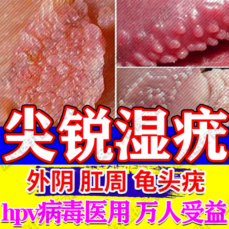 抗hpv抗病毒去疣药专用阻断人乳头瘤病毒尖锐湿疣药品男性女私处高危