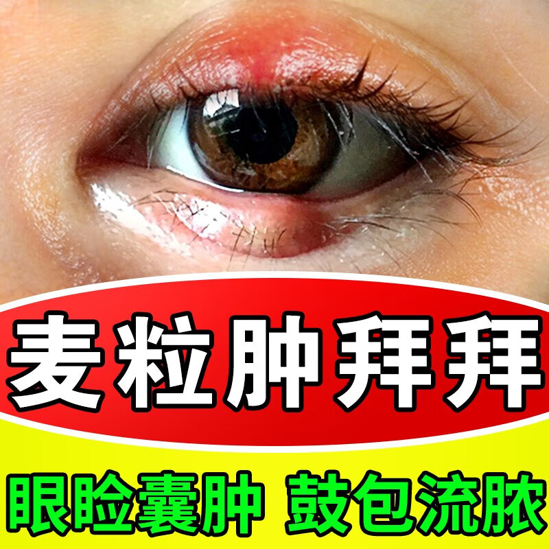 麦粒肿眼药水眼贴睑板腺堵塞红痒消药炎针眼睛水肿去霰粒肿冷热敷 单