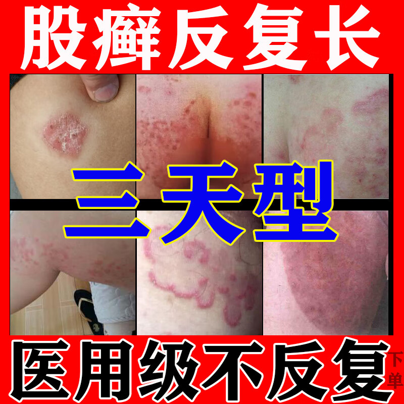 股癣藓专用药膏大腿内侧潮湿湿疹男士专用阴囊私处瘙痒止痒体癣花斑癣