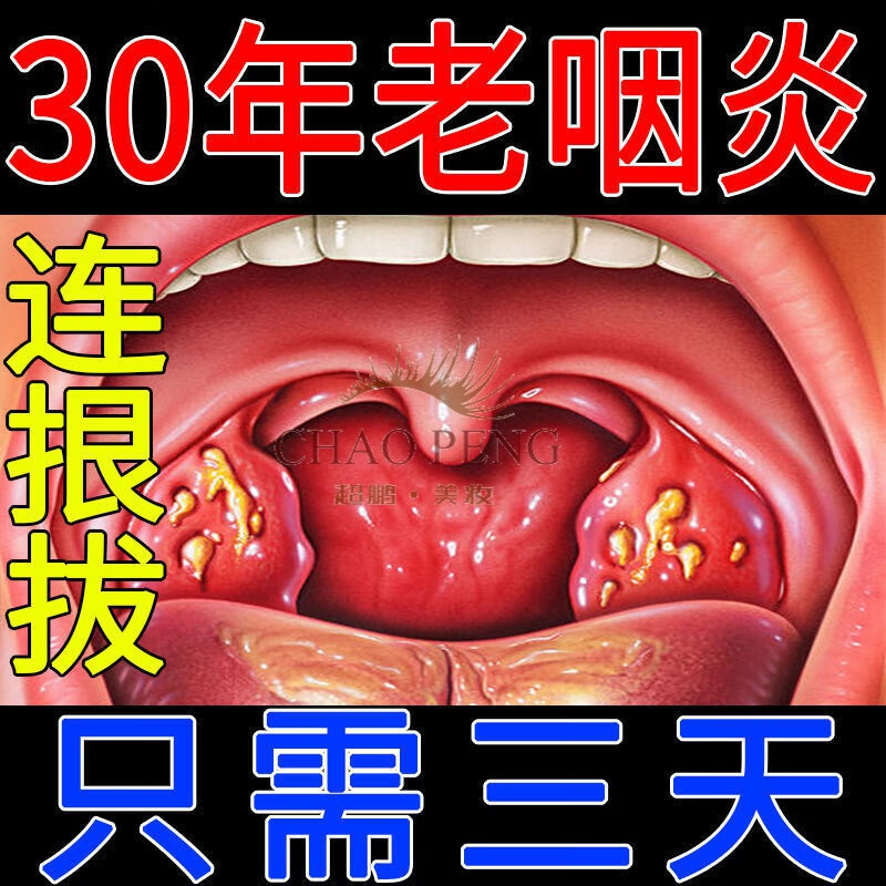 排除咽炎严重急慢性咽喉干呕干咳有痰有异物感声音嘶哑疼痛滤泡膏箹贴