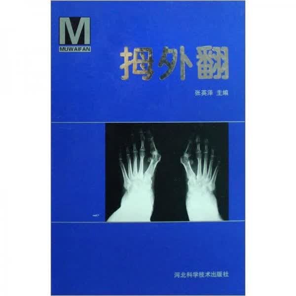 拇外翻