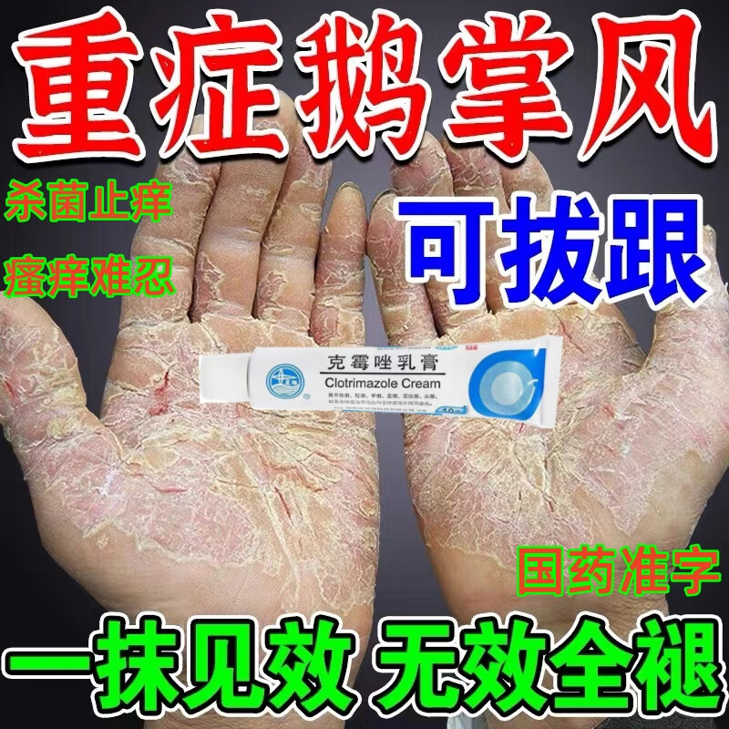 鹅掌风专用药手癣真特效药手足癣真菌感染药膏手脱皮干裂 脱皮开裂