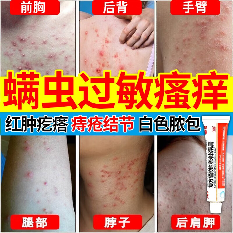 螨虫药膏螨虫过敏引起的背部后背毛囊炎 除螨祛痘胸部脸部螨虫过敏