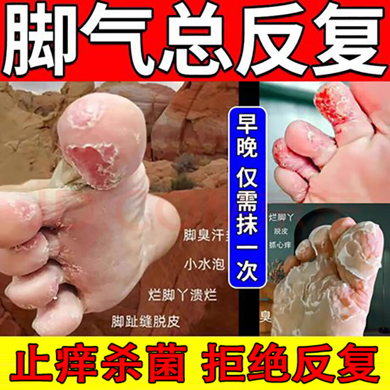 治脚气药止痒脱皮烂脚丫真菌感染止痒脚臭药足癣糜烂脚趾缝烂痒病根