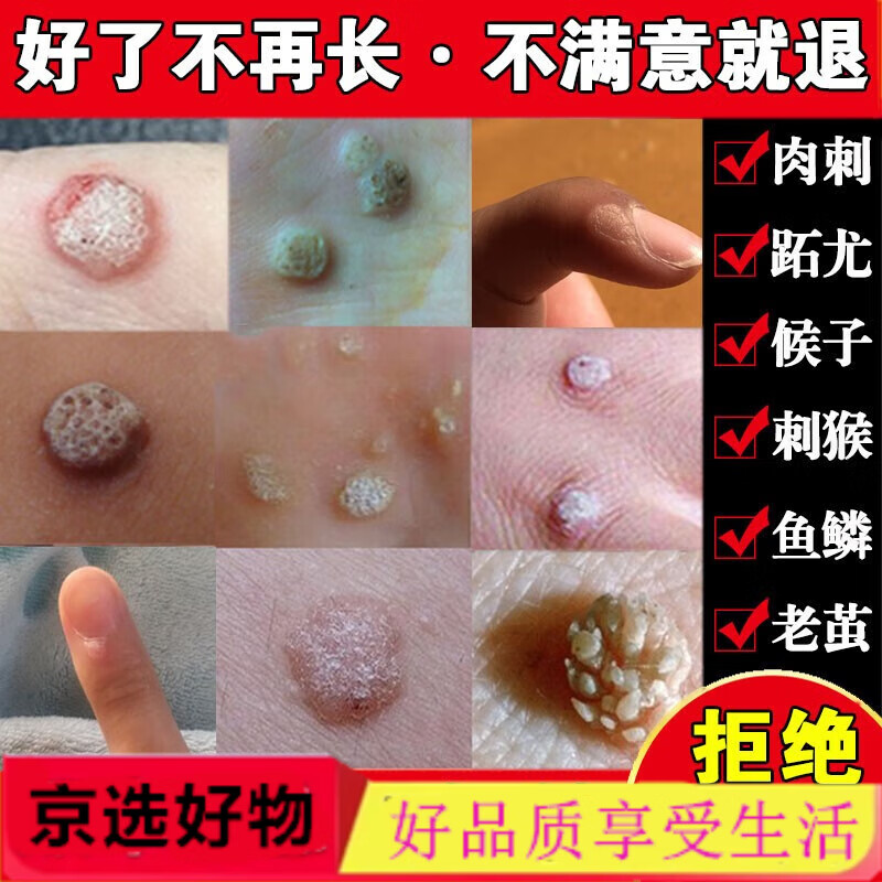【药房直发】药鱼鳞痣祛肉粒疙瘩治瘊子休子药刺猴药去除 刺猴药去除