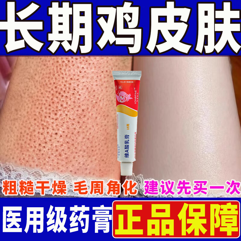 鸡皮肤疙瘩毛囊角化症专用otc药膏去看鸡皮肤毛囊角质疙瘩大腿手臂