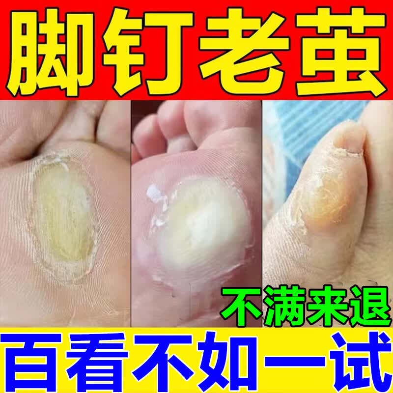 老茧软化膏茧子去除器脚底厚茧死皮角质脚趾关节茧软化剂脚后跟硬皮