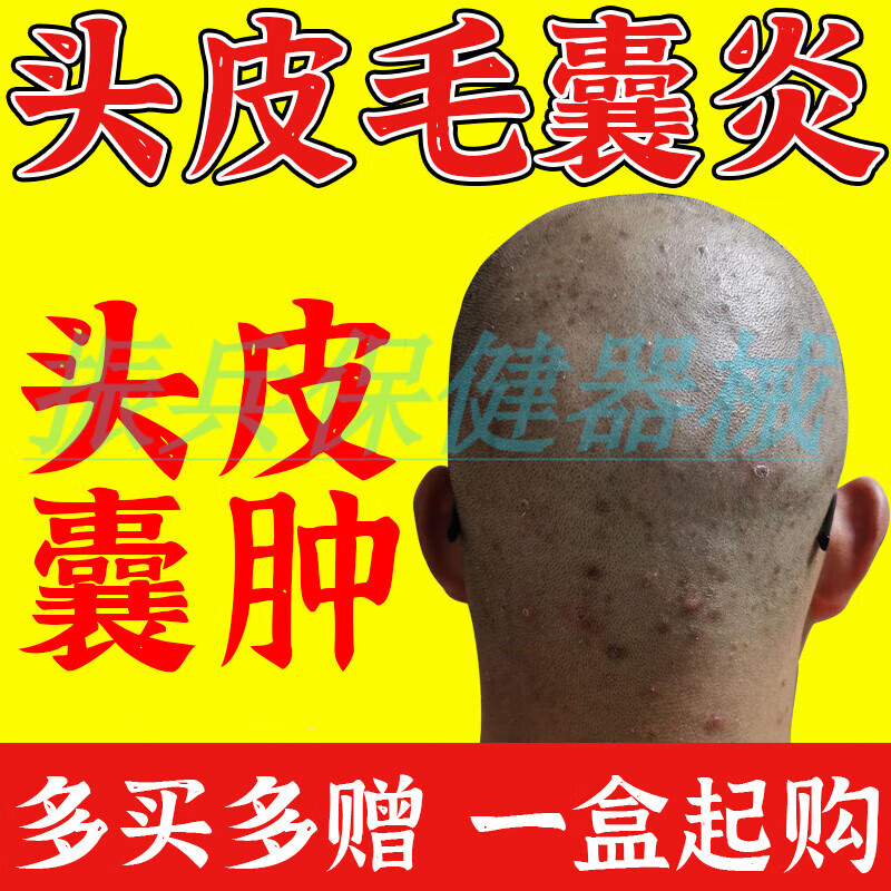【jd大药房同款直售】 毛囊丨炎头部头皮毛囊堵塞发炎洗发水头上长