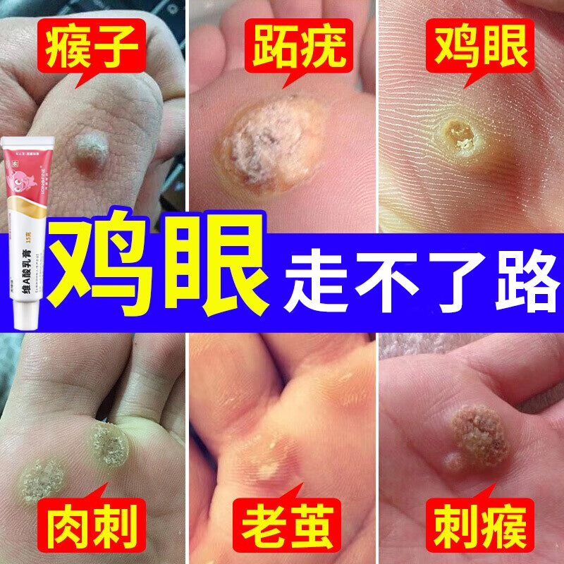 鸡眼膏 去看肉刺药膏 成人脚底脚趾鸡眼跖疣瘊子老茧走路疼痛软化角质