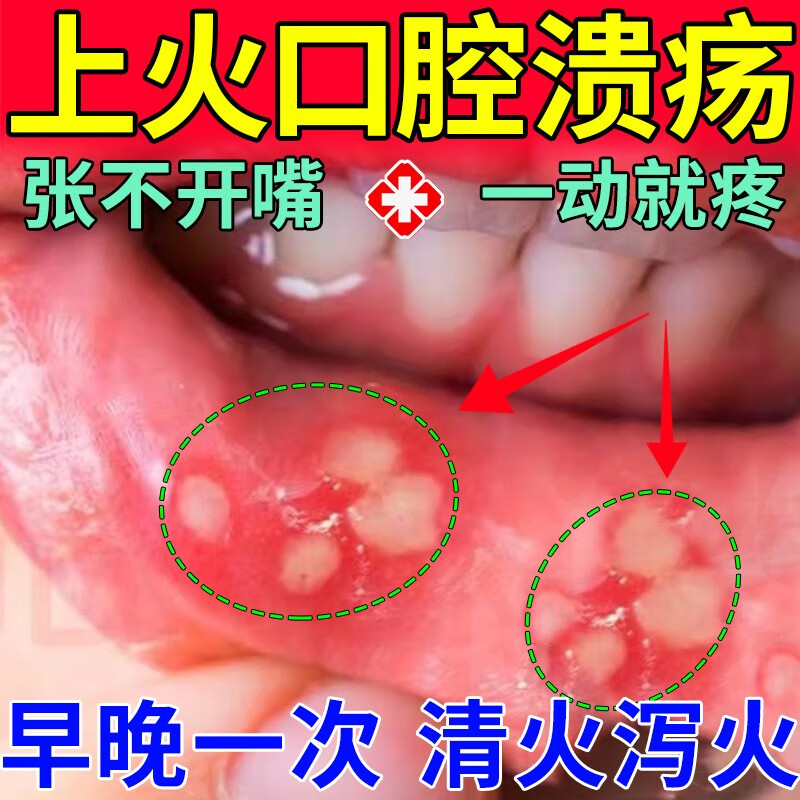 嘴巴上火起泡红肿疼痛专科用药 吃不下饭成人儿童 清火片 口腔用药 一
