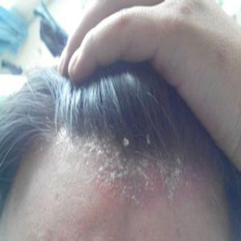 九素 去屑止痒洗发水男士女去大块头皮屑去油洗头膏洗发乳洗发露 止痒