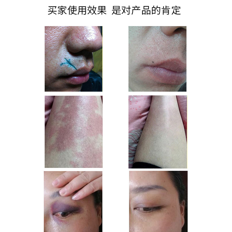 胎记去s除胎记淡化去除脸部洗纹身褐色黑色素咖啡斑脱色剂淡化胎记