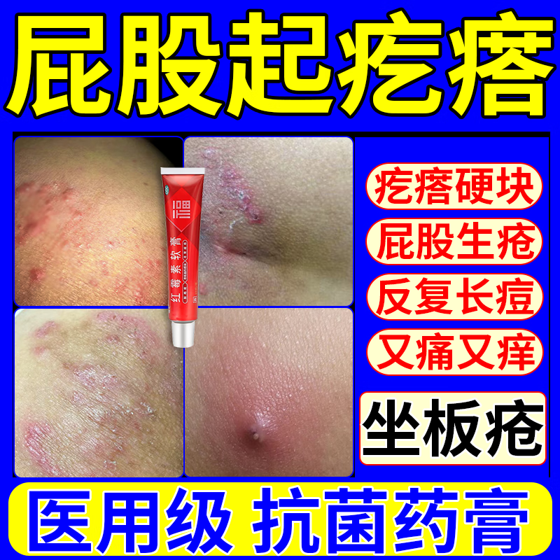 坐板疮专用药膏】屁股瘙痒久坐长坐长痘痘硬块闷头丘疹红肿疼痛脓包疮