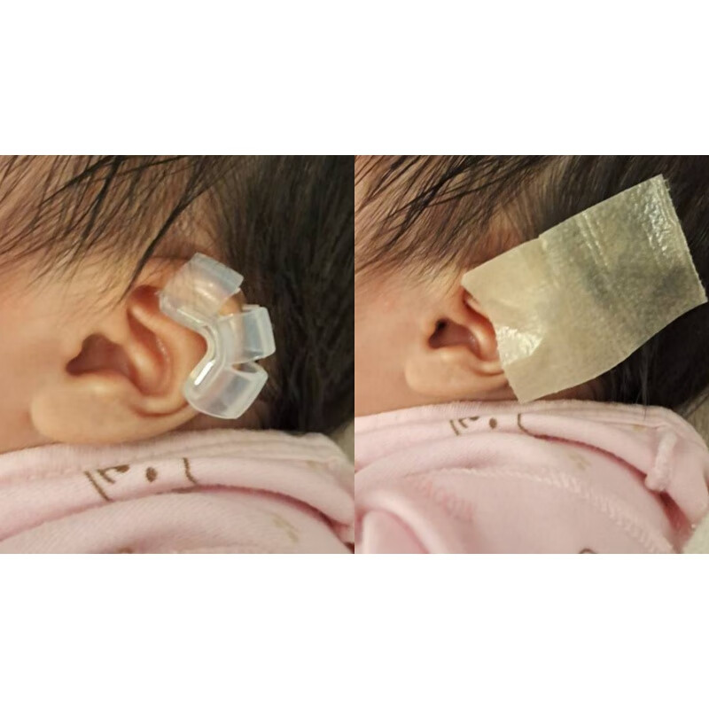 耳廓矫正器 耳廓矫正器婴儿新生儿耳朵矫形器宝宝耳畸形纠正定型垂耳