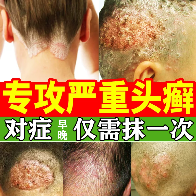 头皮癣特专心用疗效药头皮毛囊炎头部头癣药银屑头皮屑头上长红疙瘩