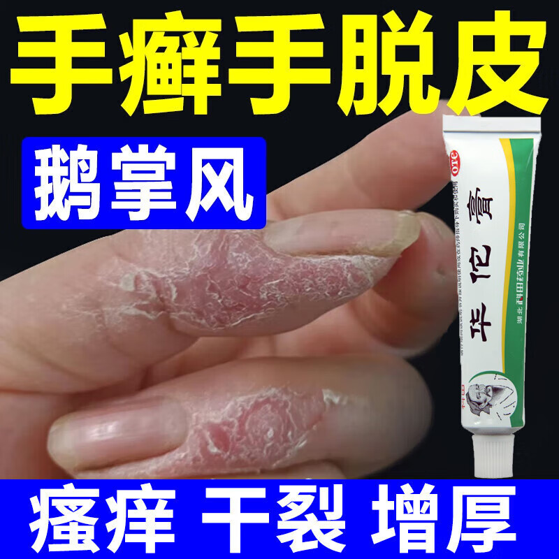 手脱皮用什么药膏 治严重脱皮真菌蜕皮干燥起皮 鹅掌风干裂脱皮膏药