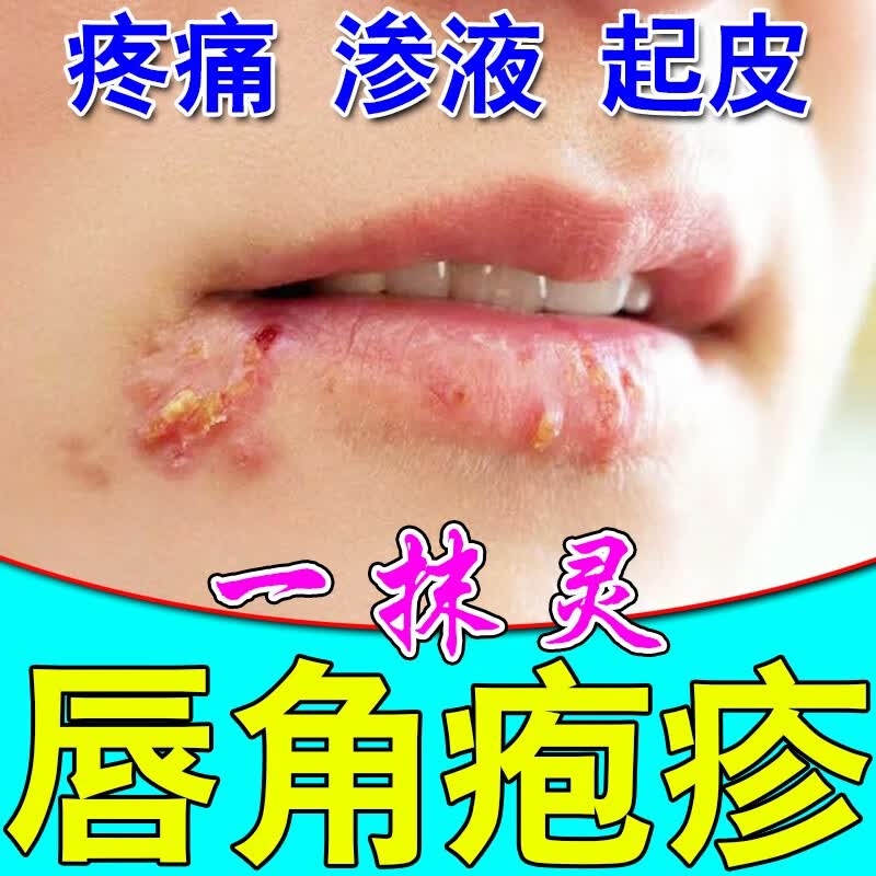 嘴唇干裂脱皮 唇炎唇愈宁唇角疱ii疹嘴角开裂唇炎唇膏治嘴巴干燥起皮