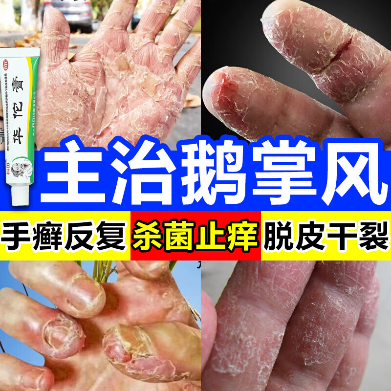 鹅掌风专用药 手癣汗疱疹手上小水泡真菌感染药膏脱皮开裂手干裂手足