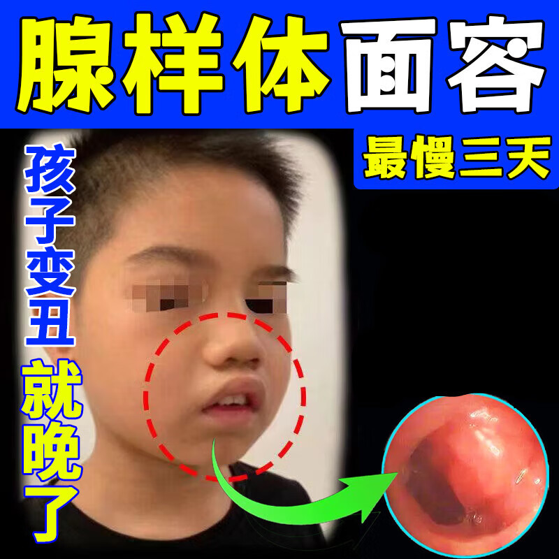 腺样体肥大中药贴 【无添加】腺样体肥大面容器宝宝睡觉张嘴 轻度单盒